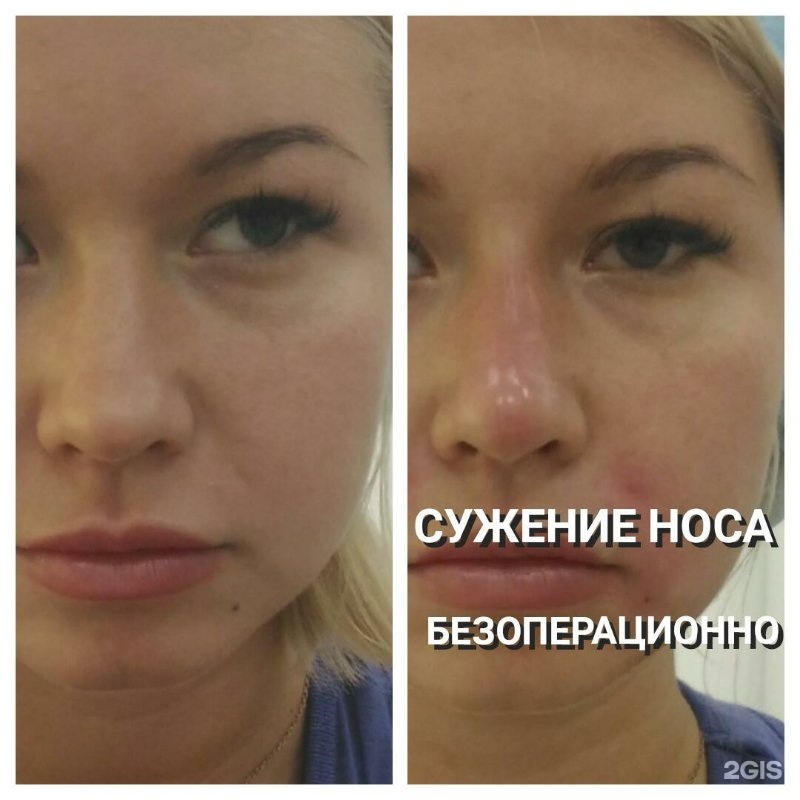 Поднятие кончика носа ботоксом фото до и после эффект