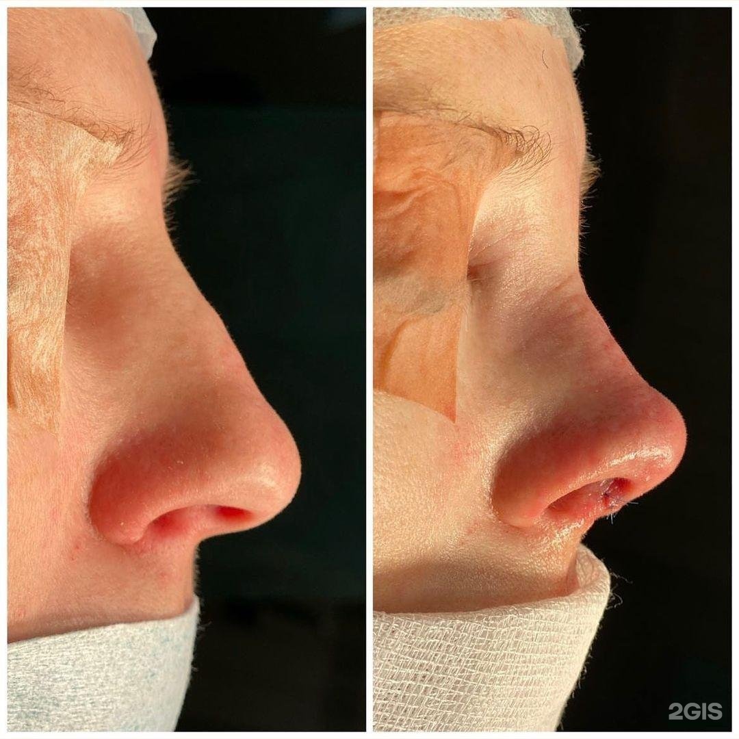 липомоделирование груди до и после. эстетпластик в махачкале. эстет пластик. слиа чеченских депутатов.